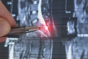 Atlanta spinal cord injury lawyer consulting with paralyzed accident victim about compensation claim